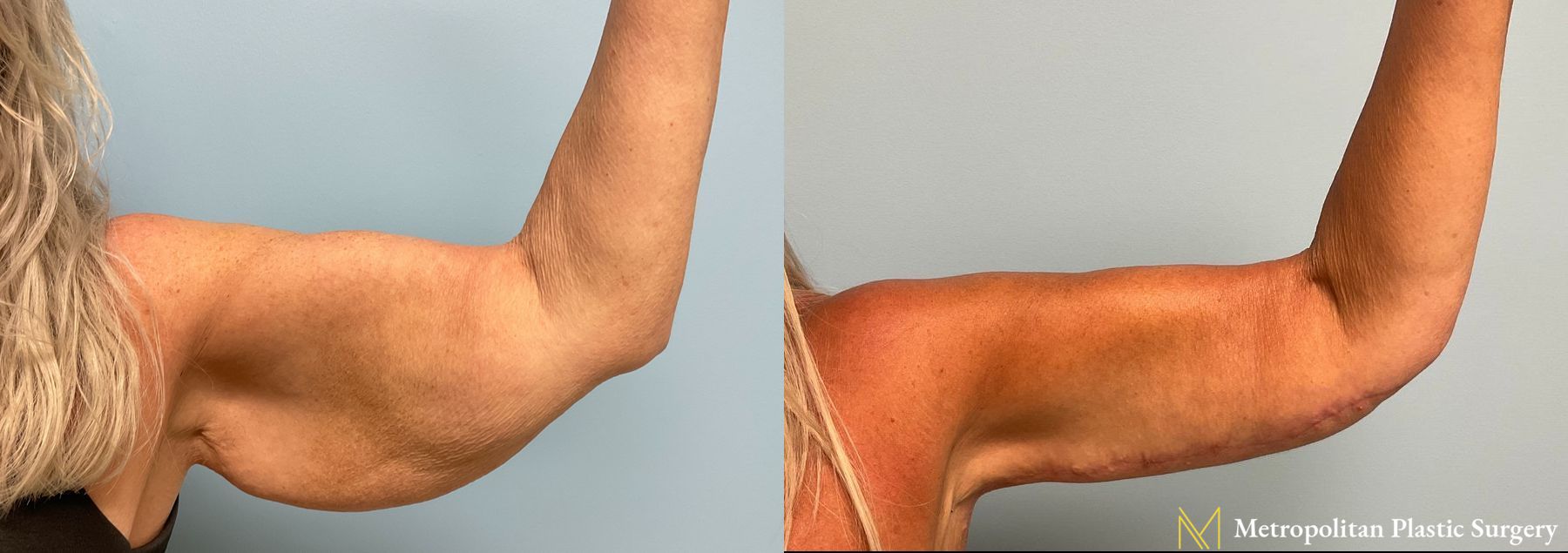 Before and after Arm Lift case 8004