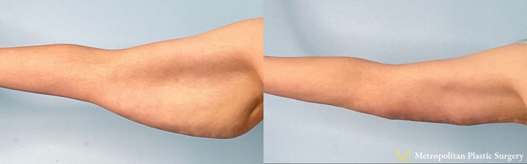 Before and after Arm Lift case 8057