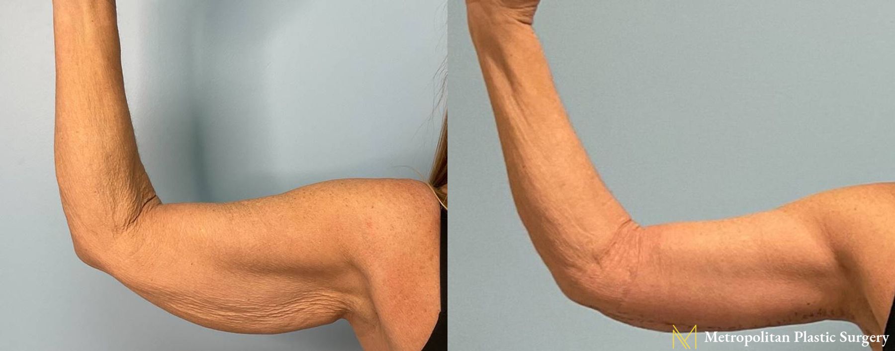 Dermal Fillers Before and After Smooth Skin Without Lines or Wrinkles