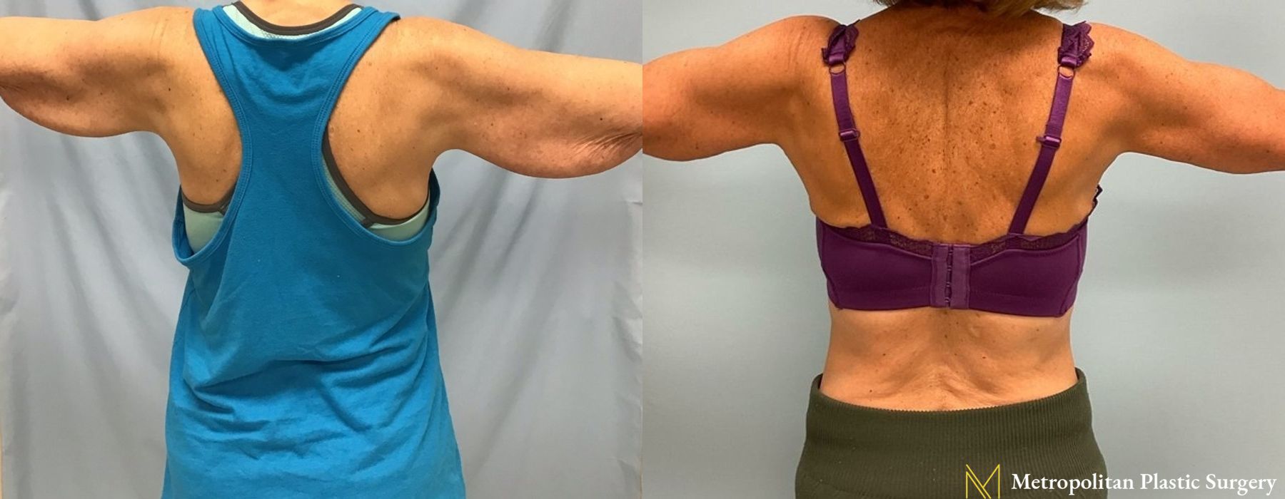 Brachioplasty - Case 79