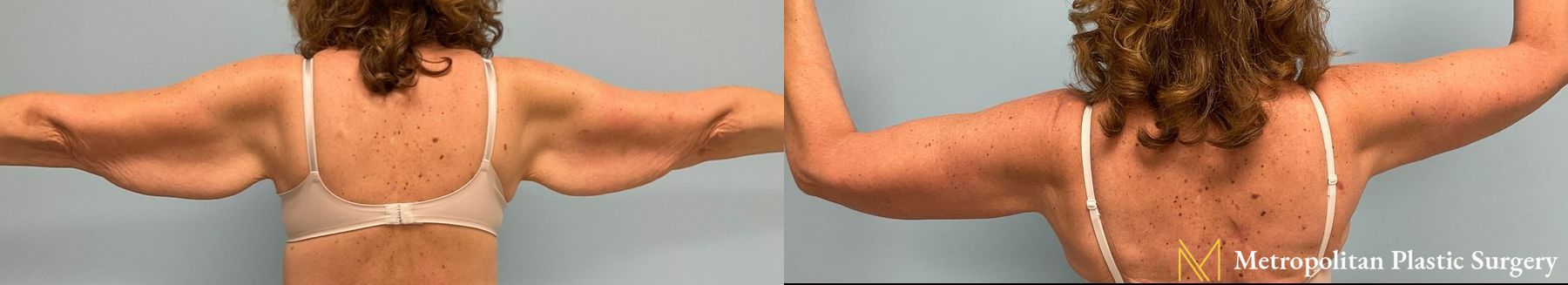 Remove Excess Arm skin and fat with Brachioplasty from Julia Spears MD - Angle 2