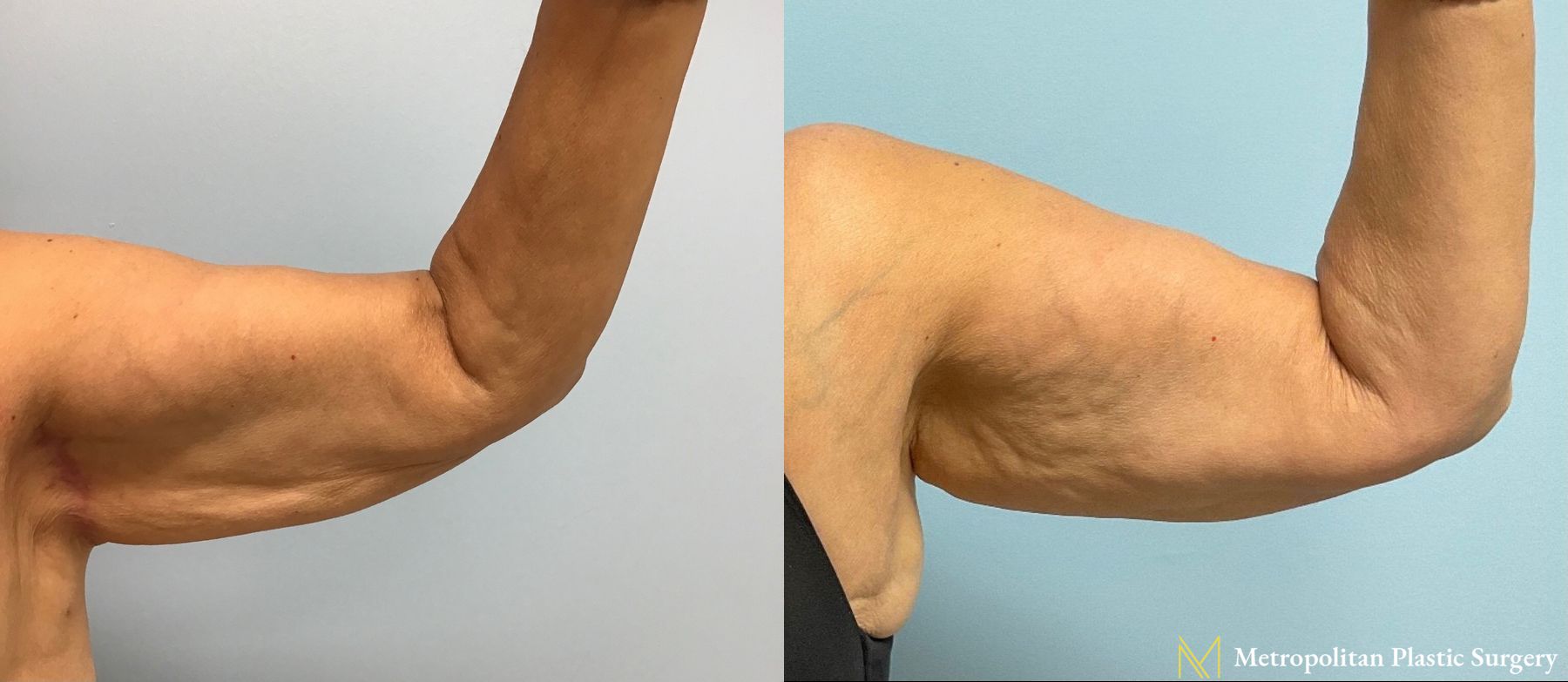 Julia Spears MD Arm Lift Surgery (Brachioplasty) Before and After - Angle 3