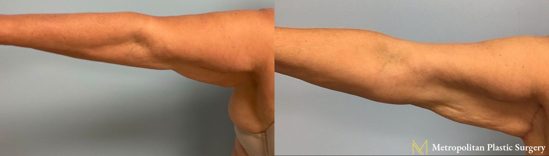 Julia Spears MD Arm Lift Surgery (Brachioplasty) Before and After - Angle 2