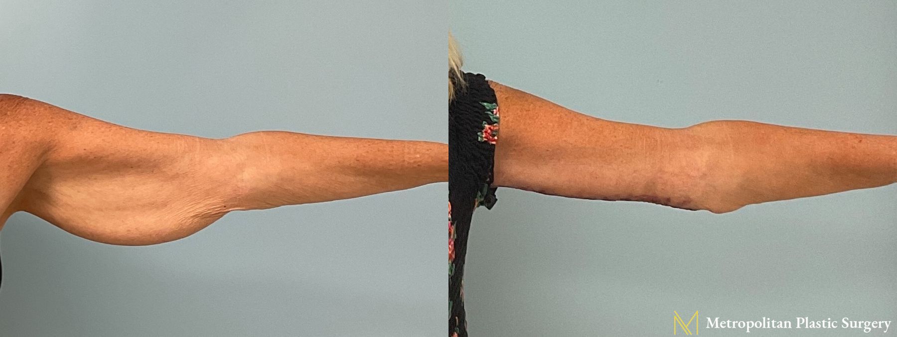 Before and after Brachioplasty photos - Angle 2