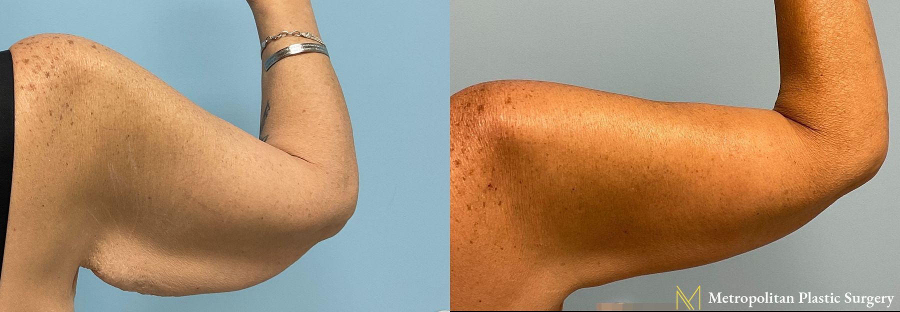 Before and after Arm Lift case 8030 - Angle 3