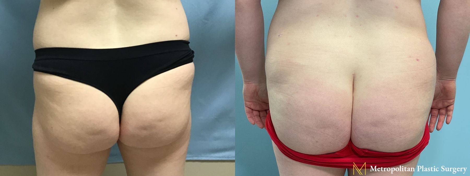 Brazlian Butt Lift performed by Dr. Julia Spears