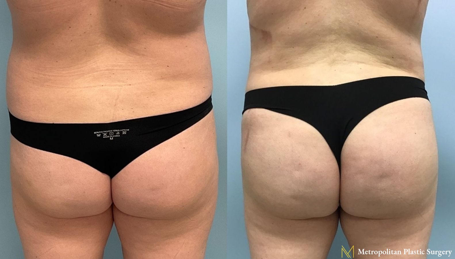 Before and after Brazilian Butt Lift case 8100