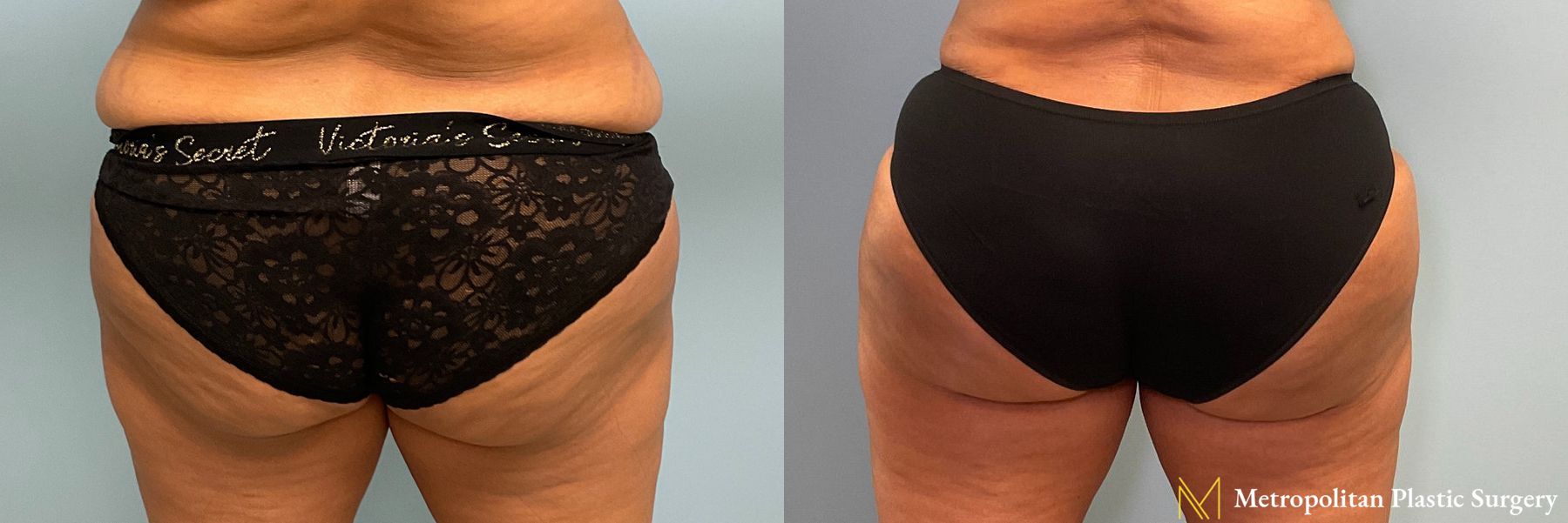 Before and after Brazilian Butt Lift case 41782