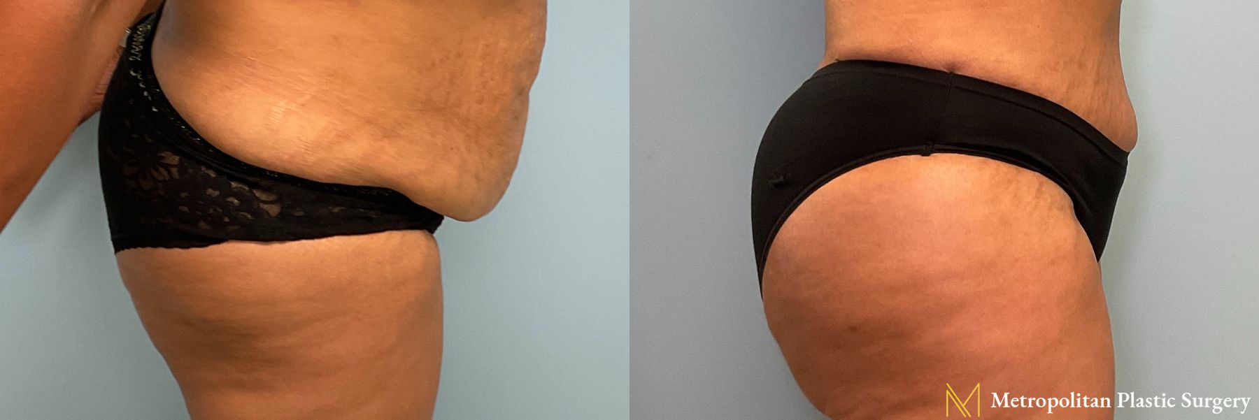 Before and after Brazilian Butt Lift case 41782 - Angle 2