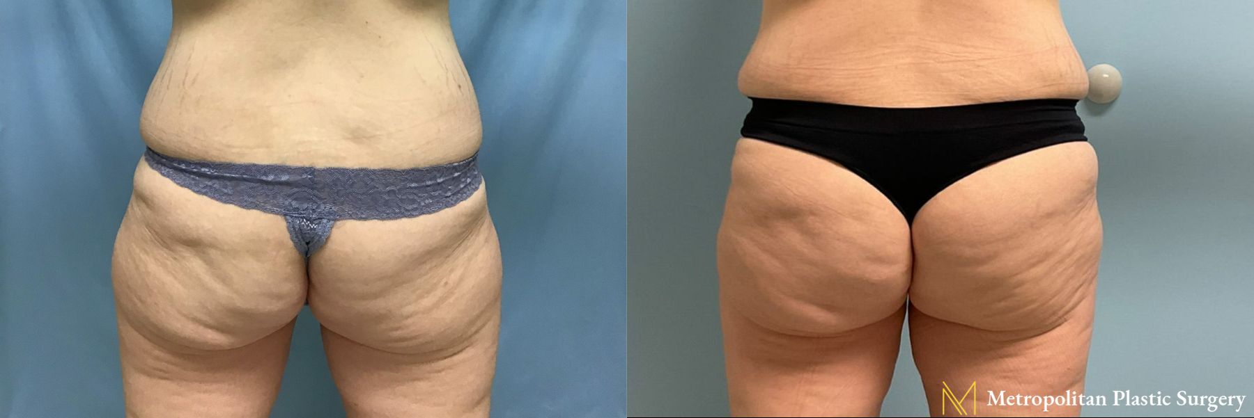 Brazilian Butt Lift performed by Dr. Julia Spears