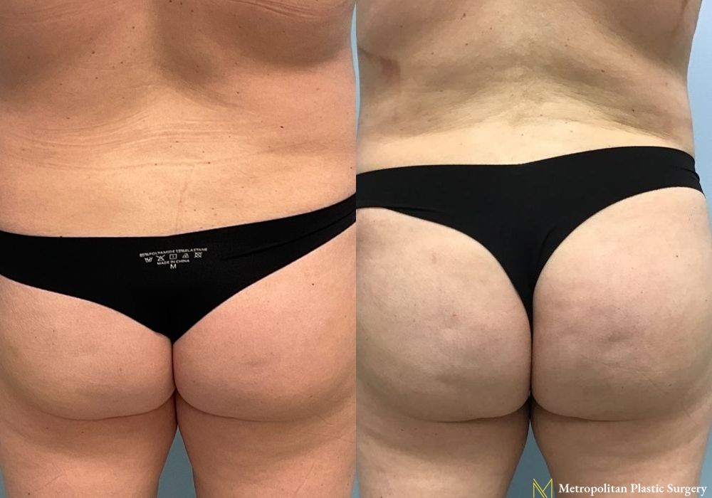 Brazilian Butt Lift - Case 87