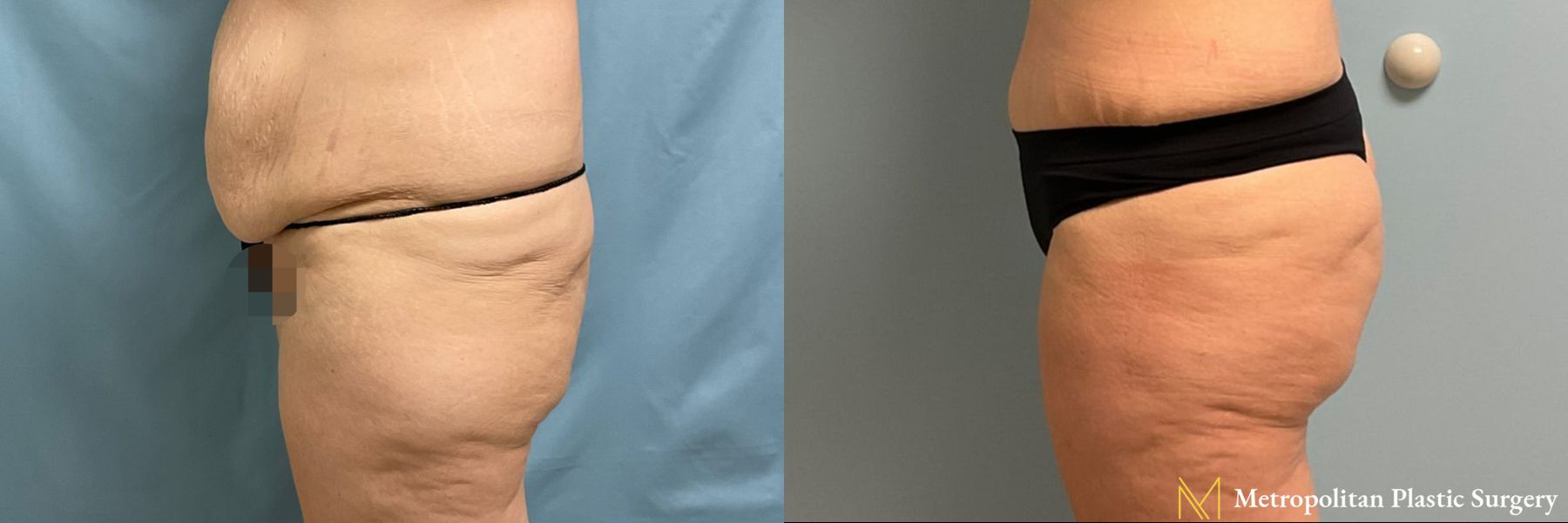 Brazilian Butt Lift performed by Dr. Julia Spears - Angle 2