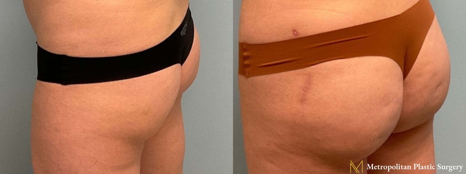 Before and after Brazilian Butt Lift case 8100 - Angle 3
