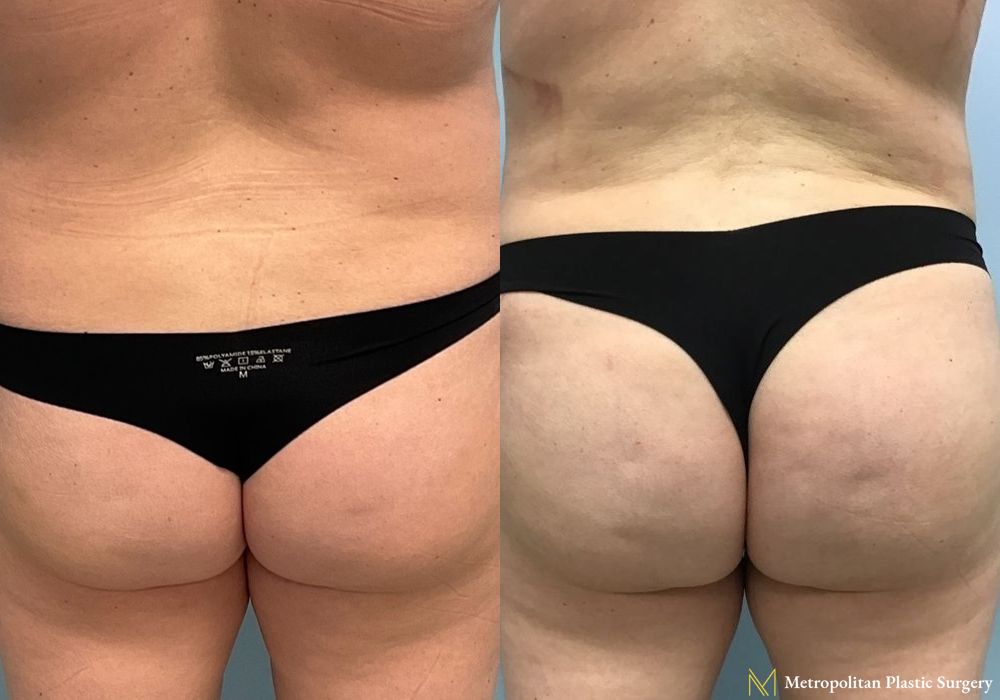 Brazilian Butt Lift - Case 190
