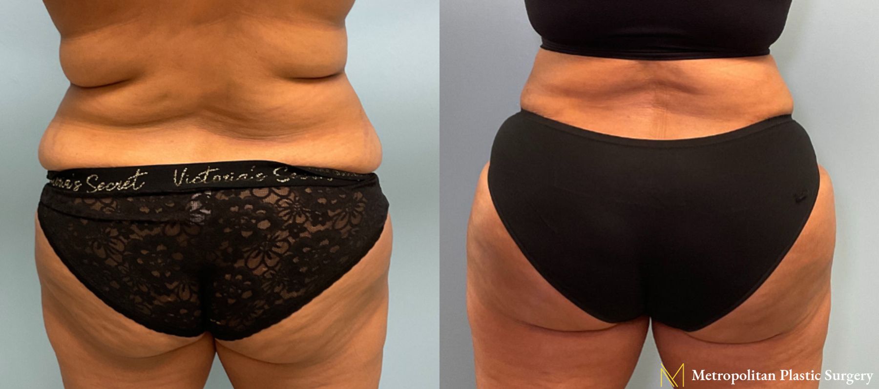 Before and after Brazilian Butt Lift case 23982 - Angle 3