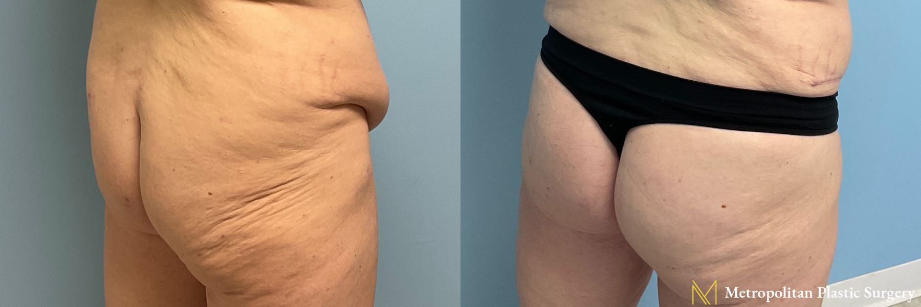 Before and after Brazilian Butt Lift case 41720 - Angle 2