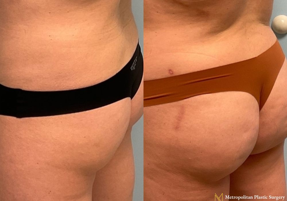 Brazilian Butt Lift - Thumbnail 3