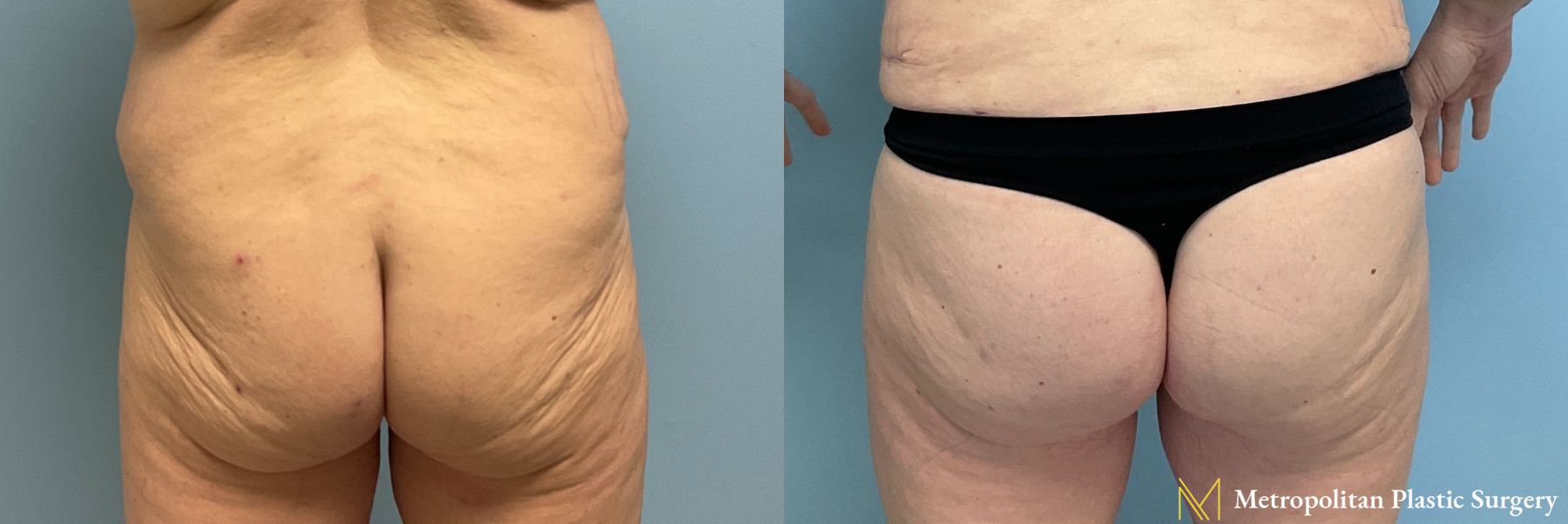 Before and after Brazilian Butt Lift case 41720