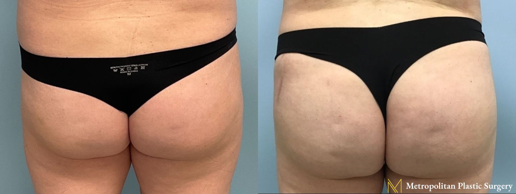 Before and after Brazilian Butt Lift case 8100
