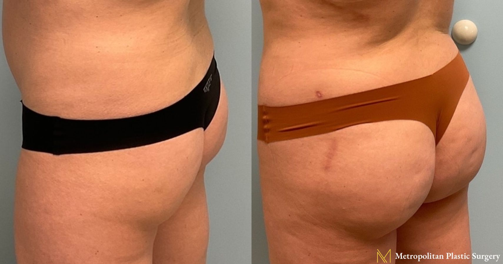 Before and after Brazilian Butt Lift case 8100 - Angle 3