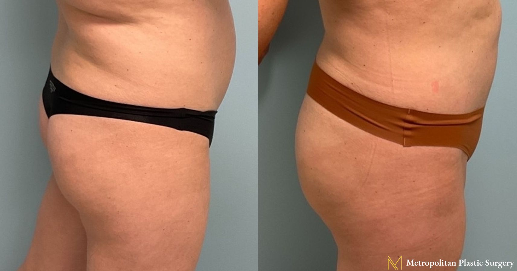 Before and after Brazilian Butt Lift case 8100 - Angle 2