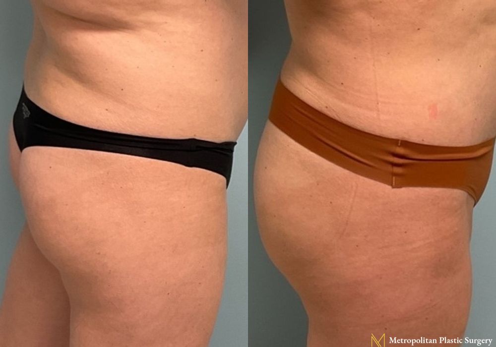 Brazilian Butt Lift - Thumbnail 2