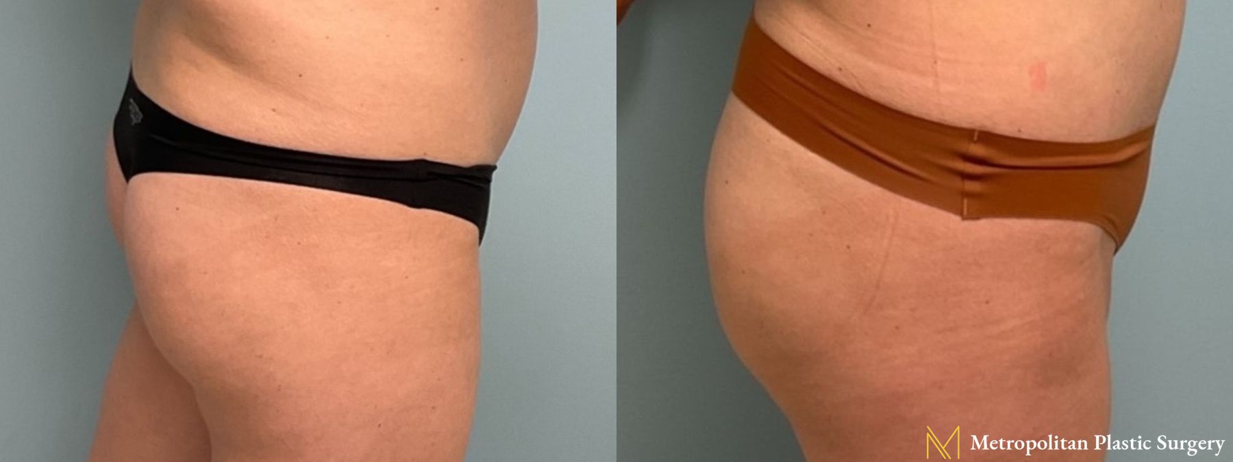 Before and after Brazilian Butt Lift case 8100 - Angle 2