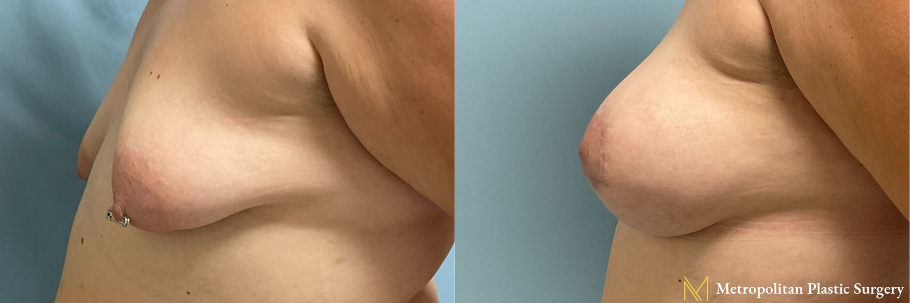 Breast Augmentation (Mammoplasty) by Julia Spears MD Before and After - Angle 4