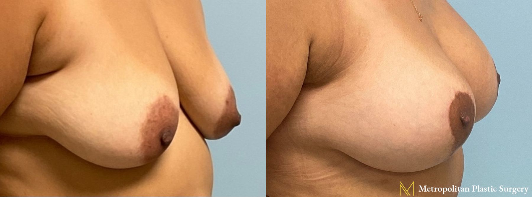 Before and after Breast Augmentation case 8061 - Angle 3