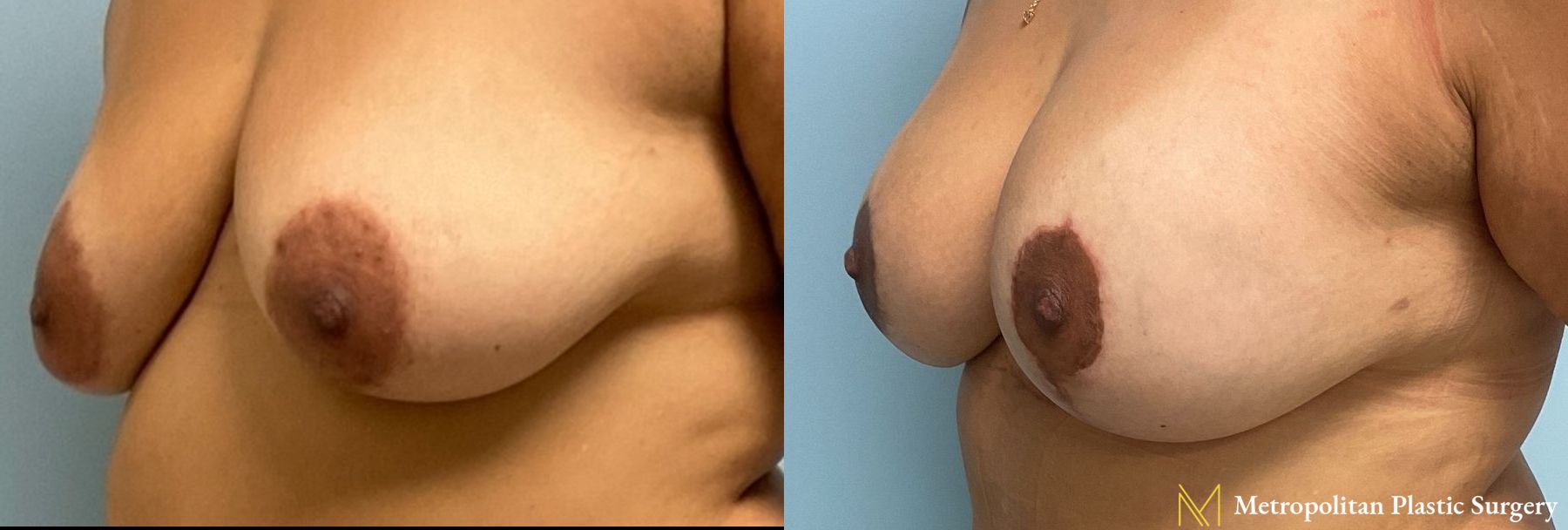 Before and after Breast Augmentation case 8061 - Angle 5