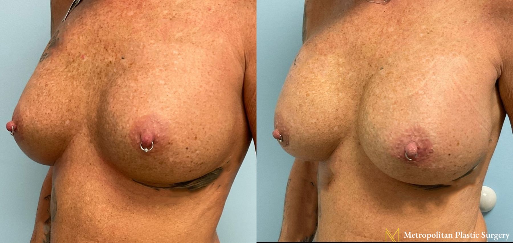 Breast Augmentation (Mammoplasty) by Julia Spears MD Before and After - Angle 5