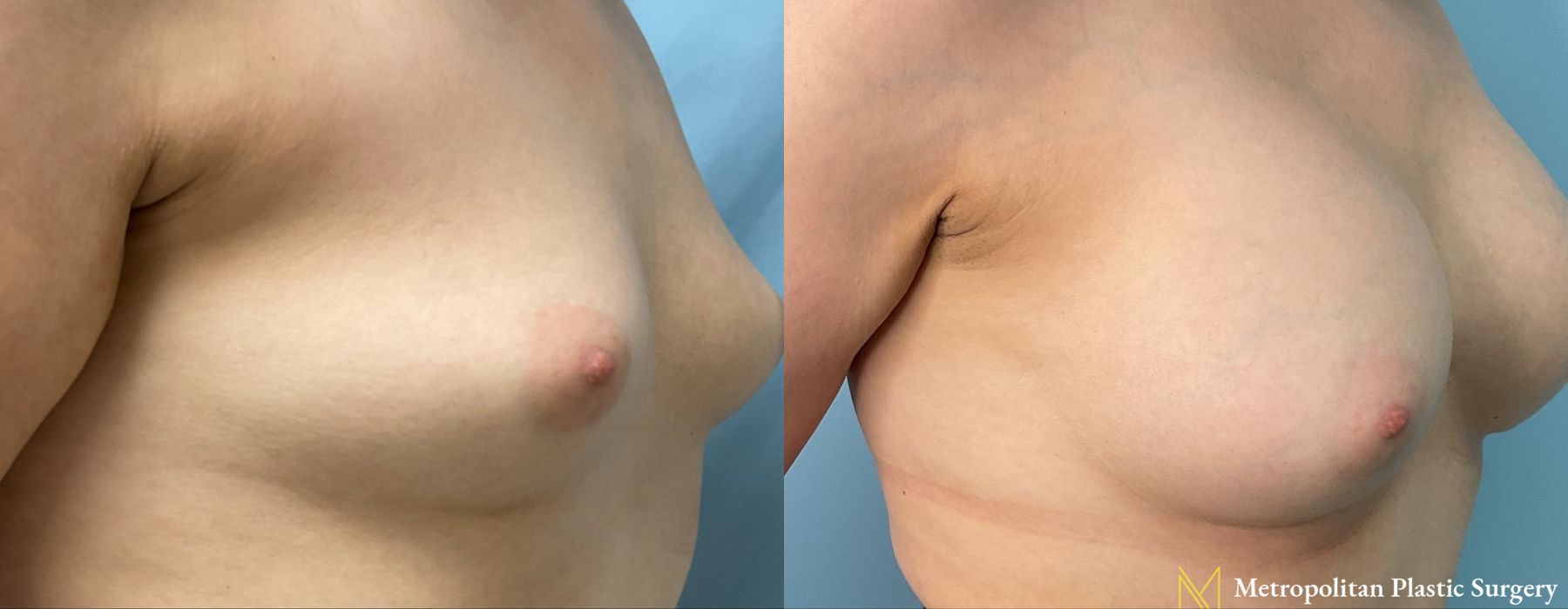 Before and after Breast Augmentation case 13040 - Angle 2