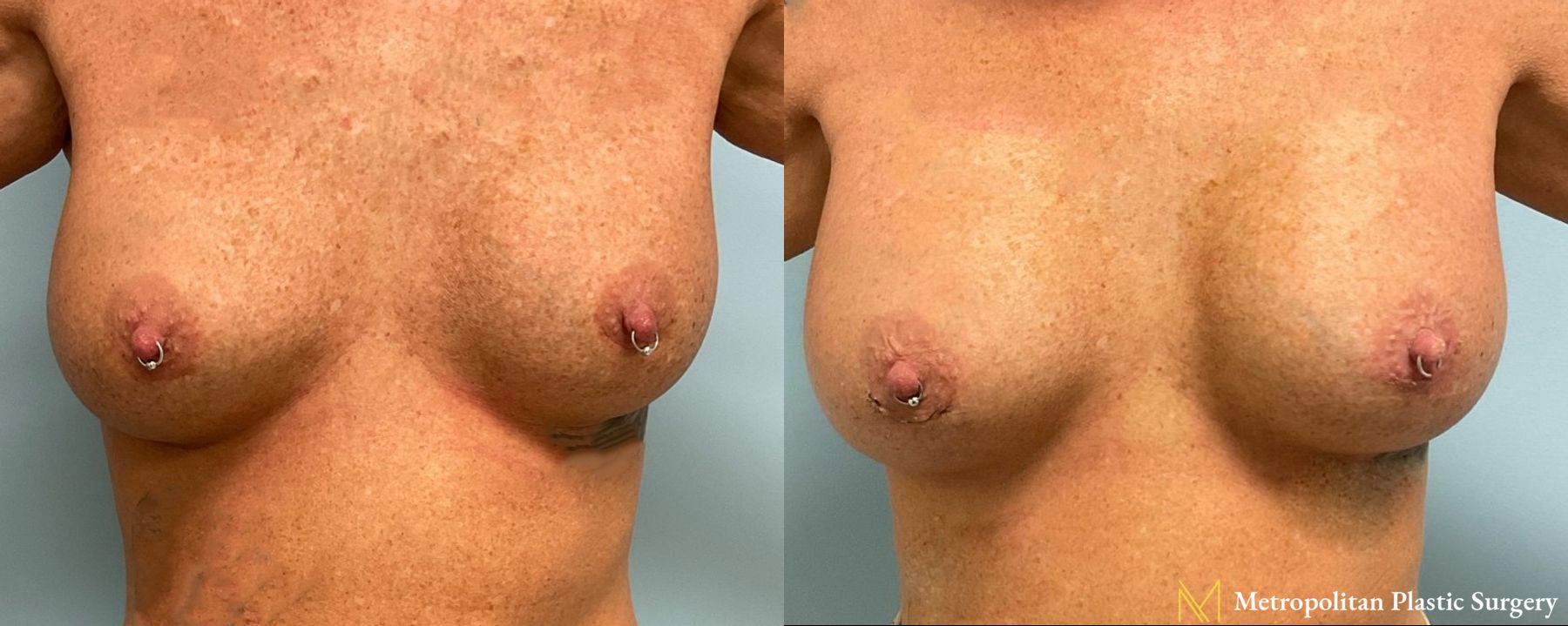 Breast Augmentation (Mammoplasty) by Julia Spears MD Before and After