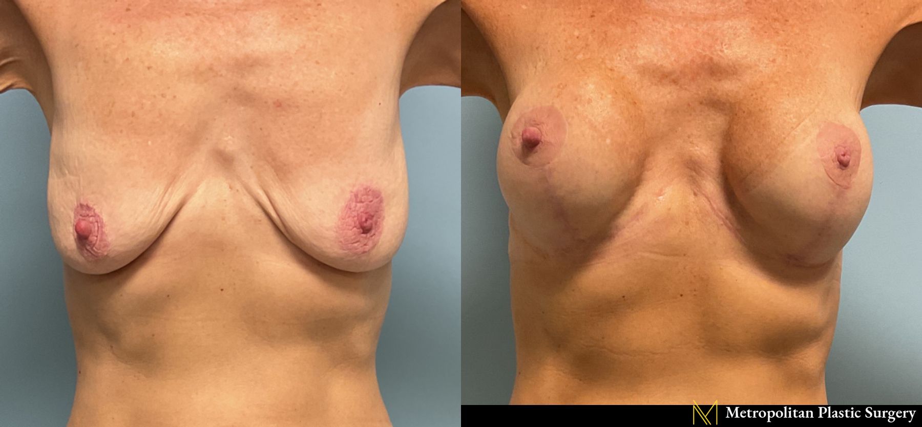 Breast Augmentation with Lift performed by Dr. Julia Spears, MD, FACS