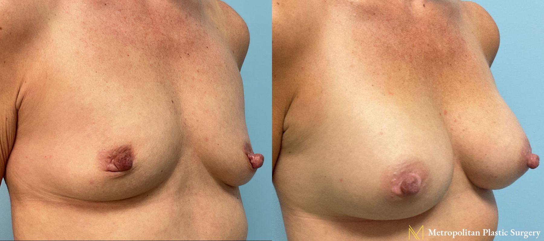 Before and after Breast Augmentation case 23811 - Angle 2