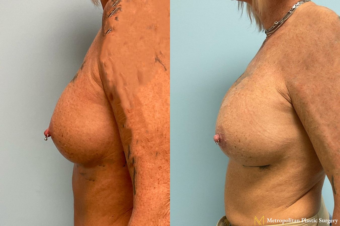 Breast Augmentation (Mammoplasty) by Julia Spears MD Before and After - Angle 4