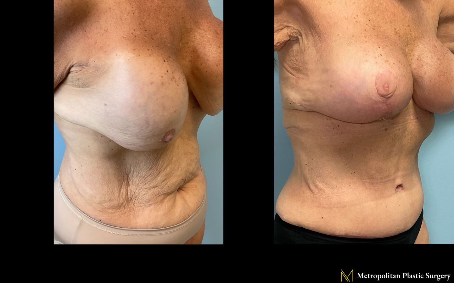 Before and after Tummy Tuck case 23903 - Angle 3