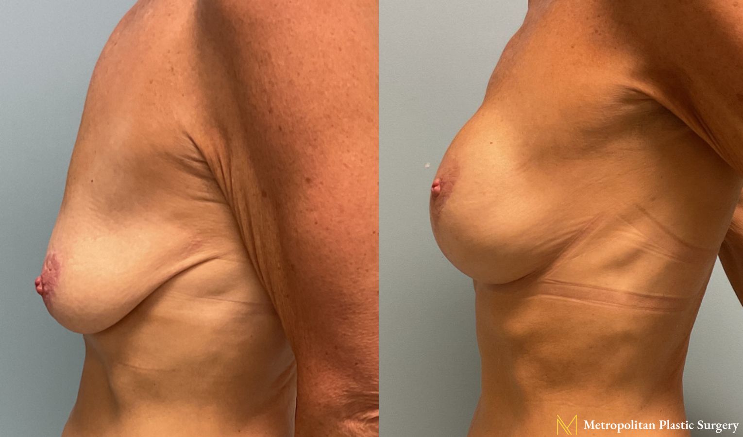 Breast Augmentation with Lift performed by Dr. Julia Spears, MD, FACS - Angle 3