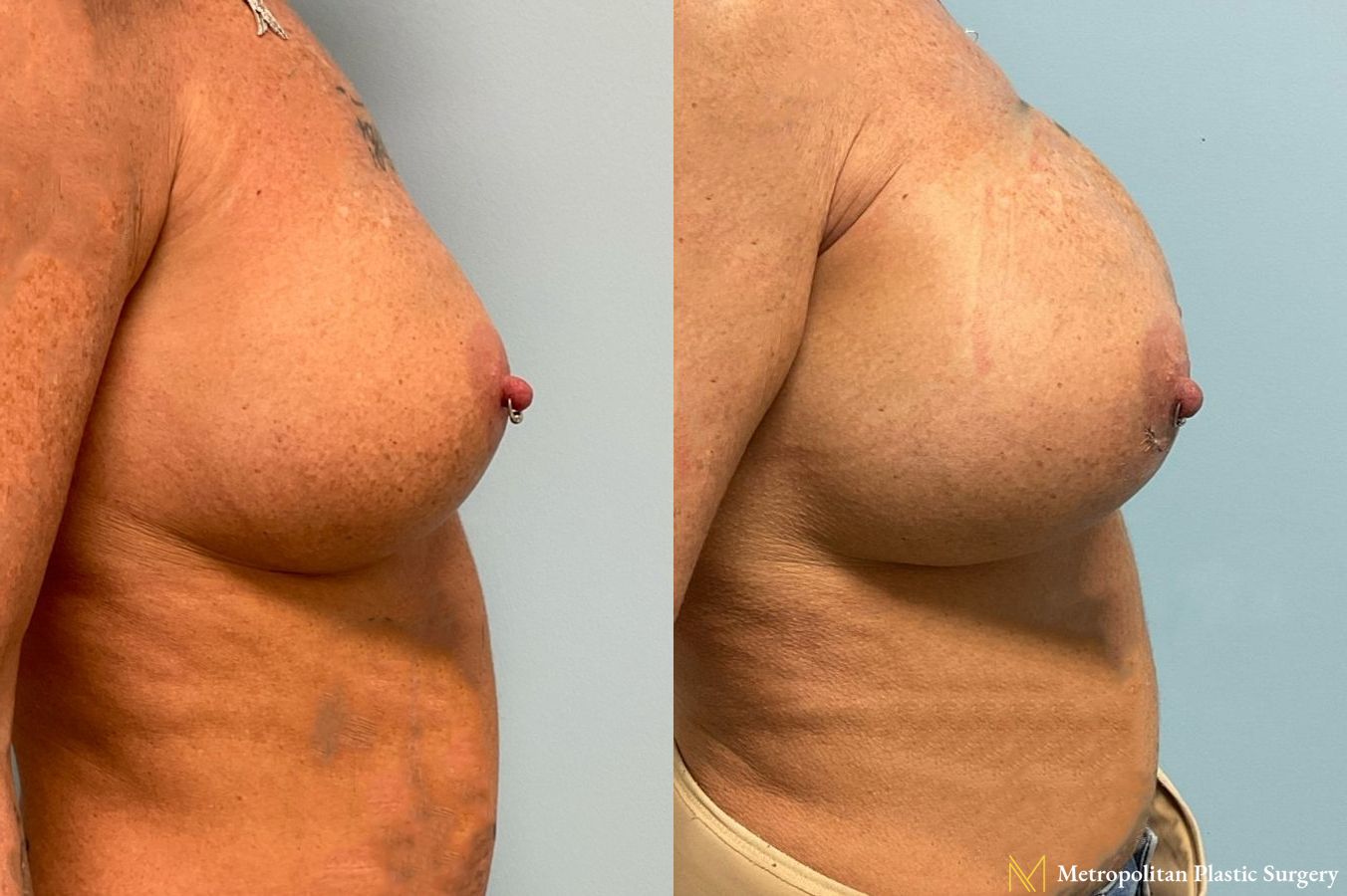 Breast Augmentation (Mammoplasty) by Julia Spears MD Before and After - Angle 2
