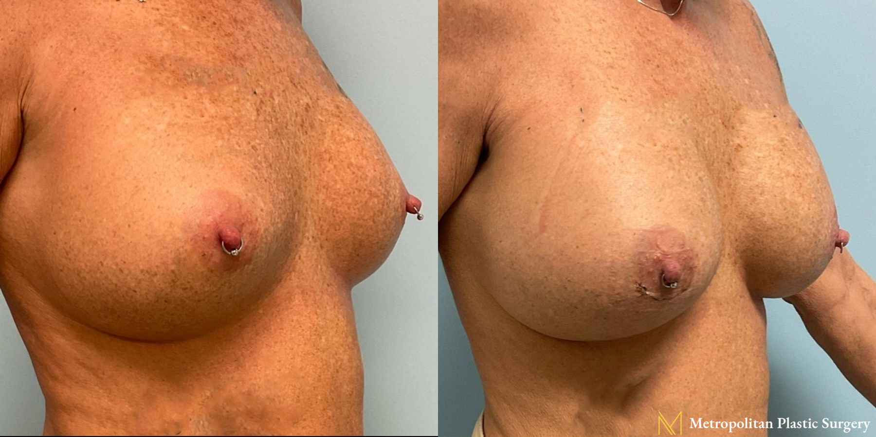 Breast Augmentation (Mammoplasty) by Julia Spears MD Before and After - Angle 3