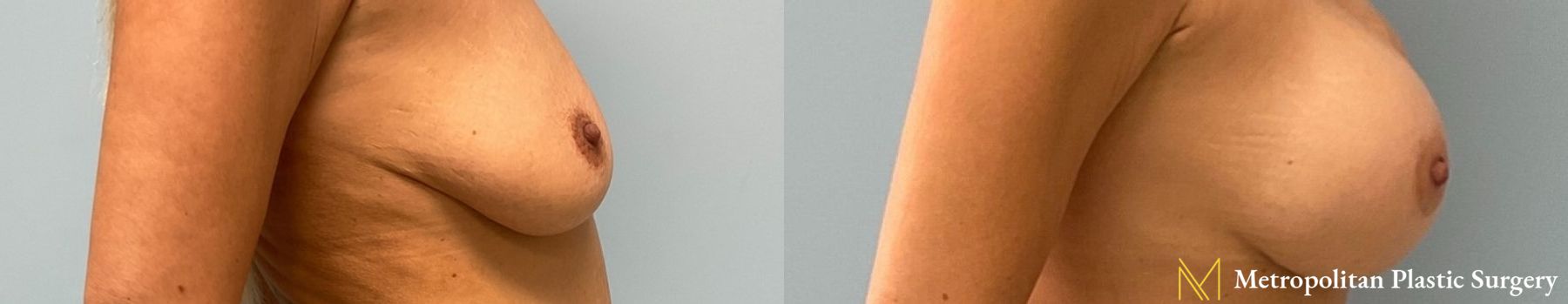 Before and after Breast Augmentation case 8102 - Angle 2