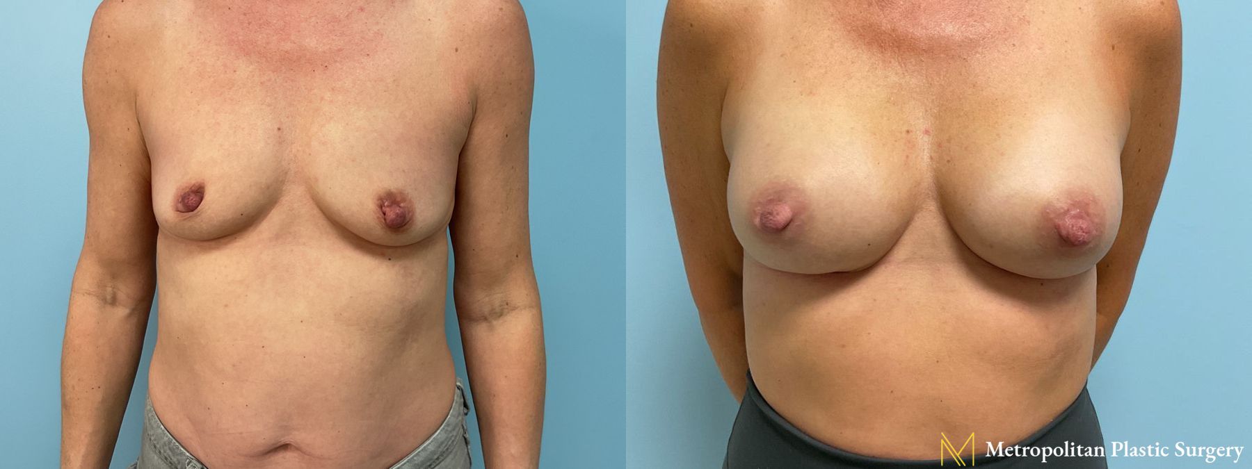 Before and after Breast Augmentation case 23811