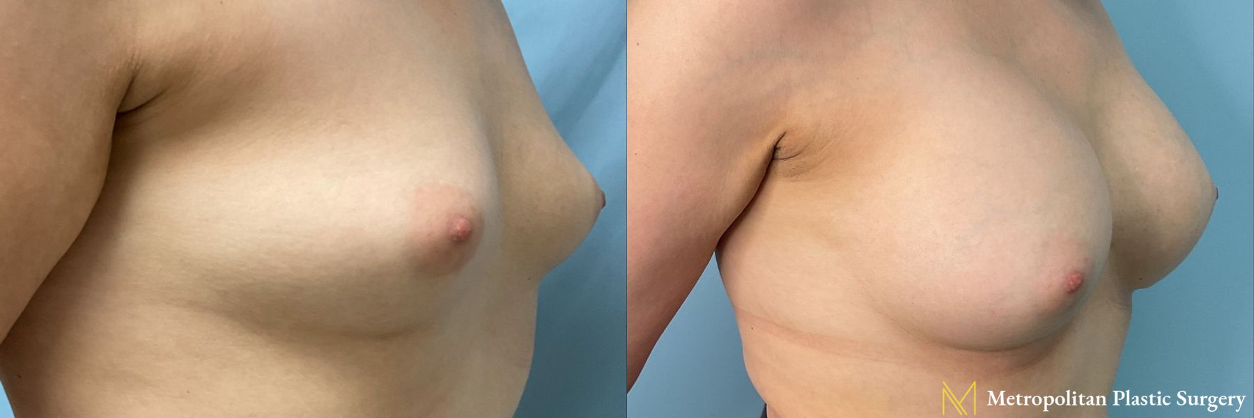 Before and after Breast Augmentation case 23852 - Angle 2