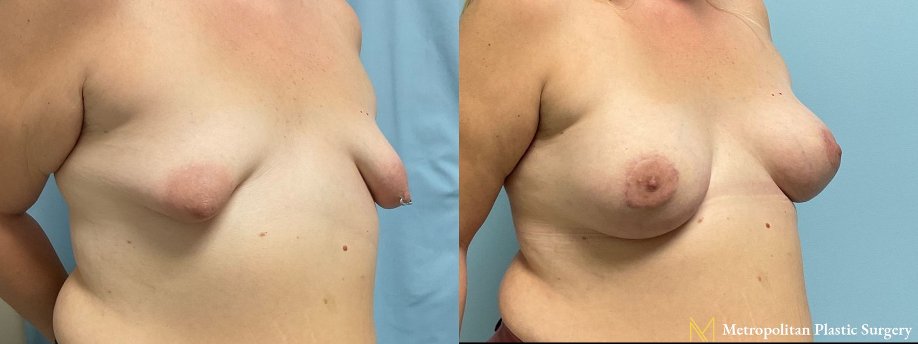 Breast Augmentation (Mammoplasty) by Julia Spears MD Before and After - Angle 3