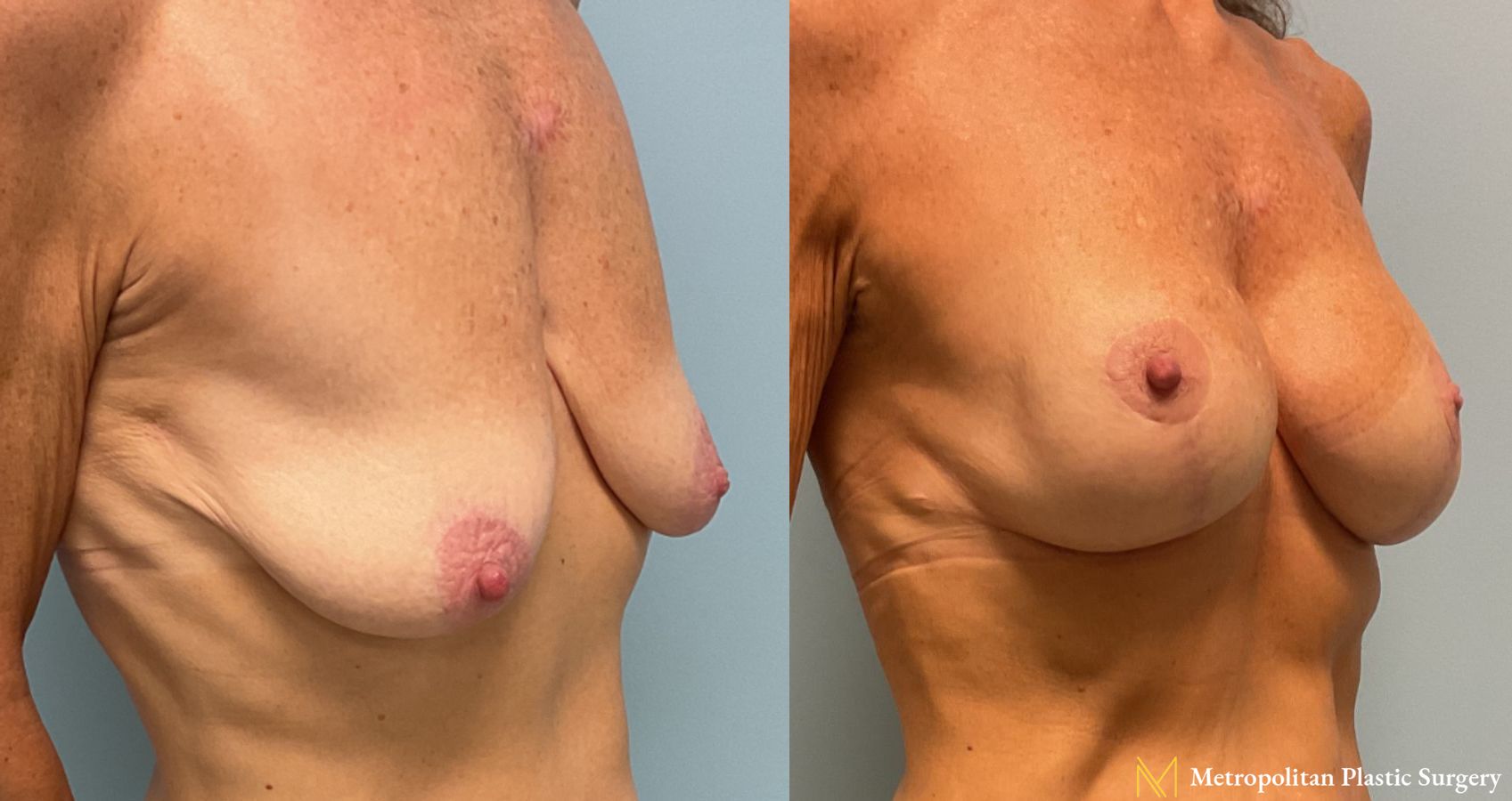 Breast Augmentation with Lift performed by Dr. Julia Spears, MD, FACS - Angle 2