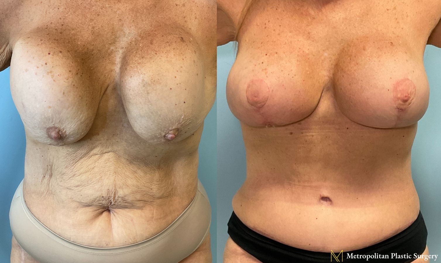 Before and after Tummy Tuck case 23903
