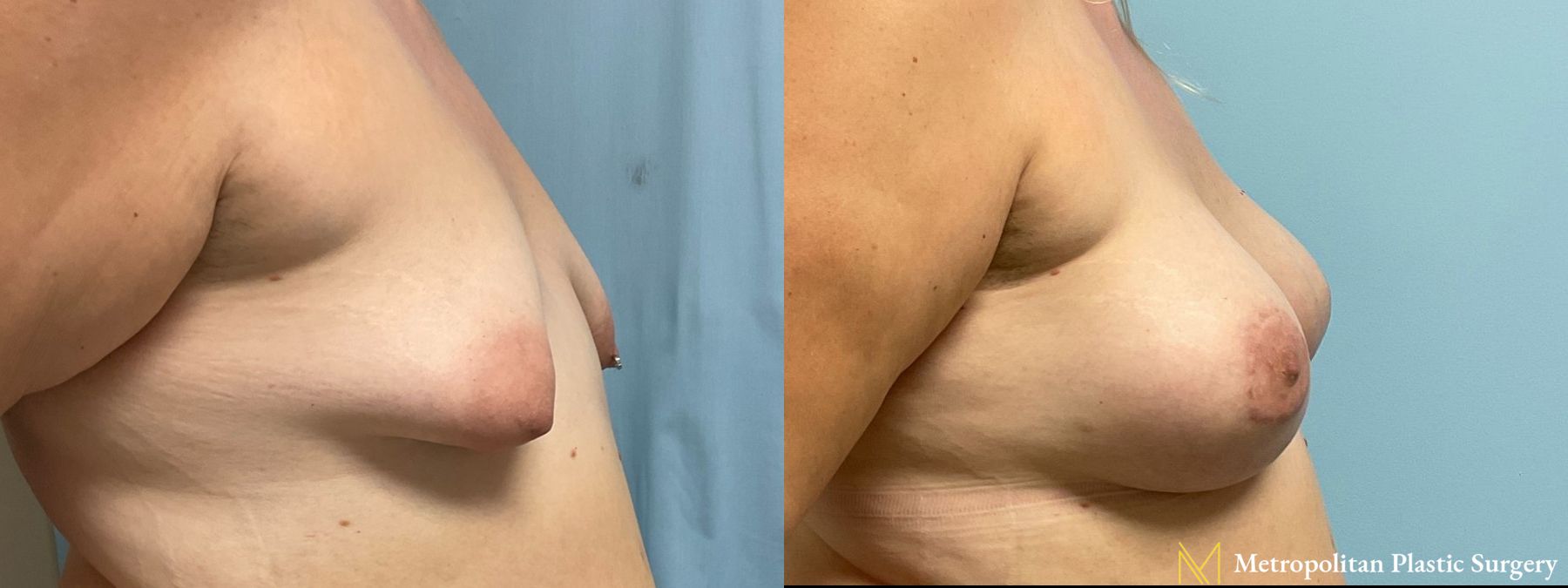 Breast Augmentation (Mammoplasty) by Julia Spears MD Before and After - Angle 2