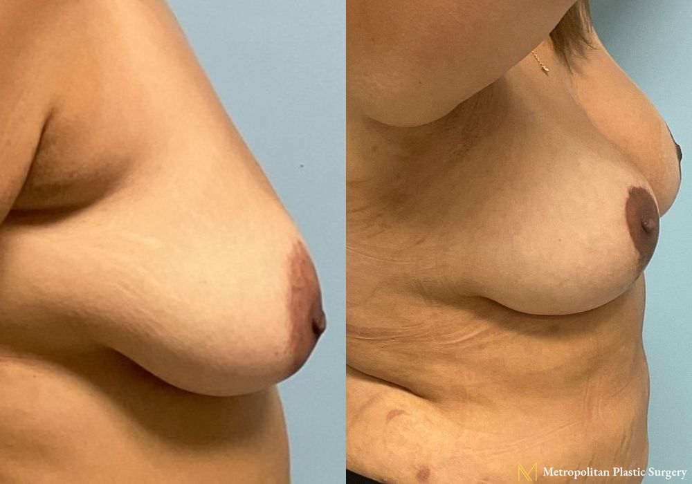 Before and after Breast Augmentation case 8061 - Angle 2