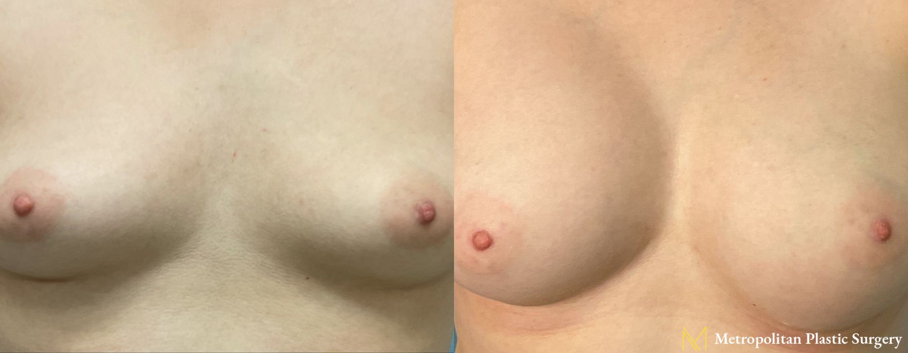 Before and after Breast Augmentation case 23852