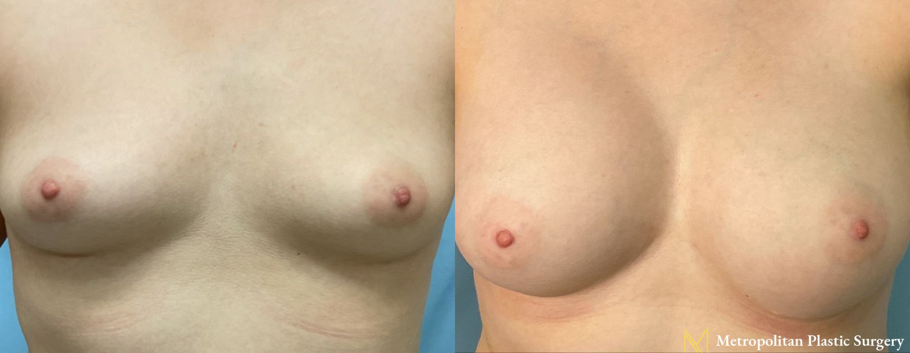 Before and after Breast Augmentation case 13040